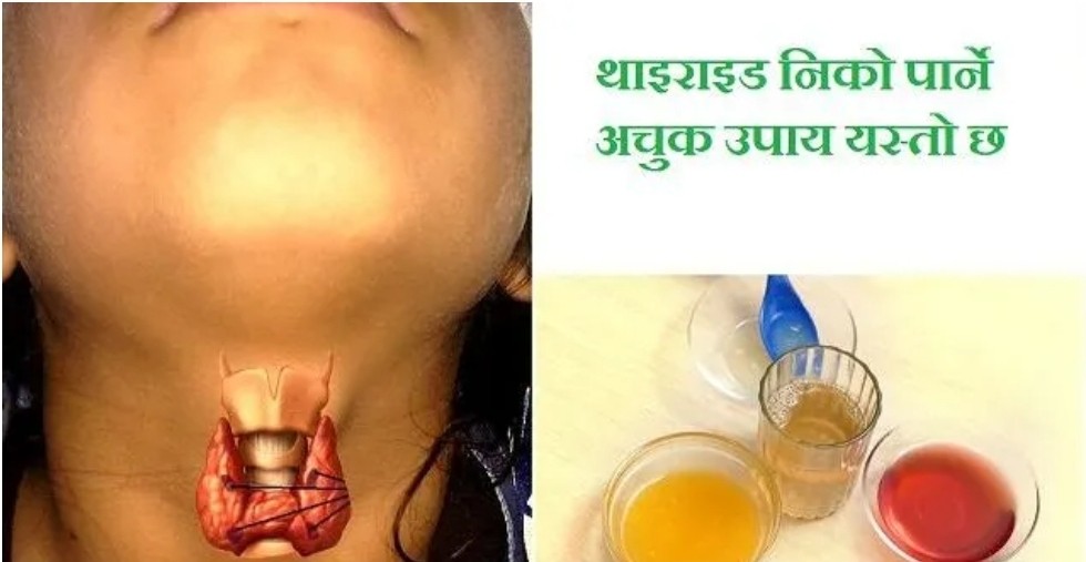 थाइराईडको अचुक औषधि